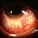 Possible CMV Retinitis with Frosted Branch Angiitis